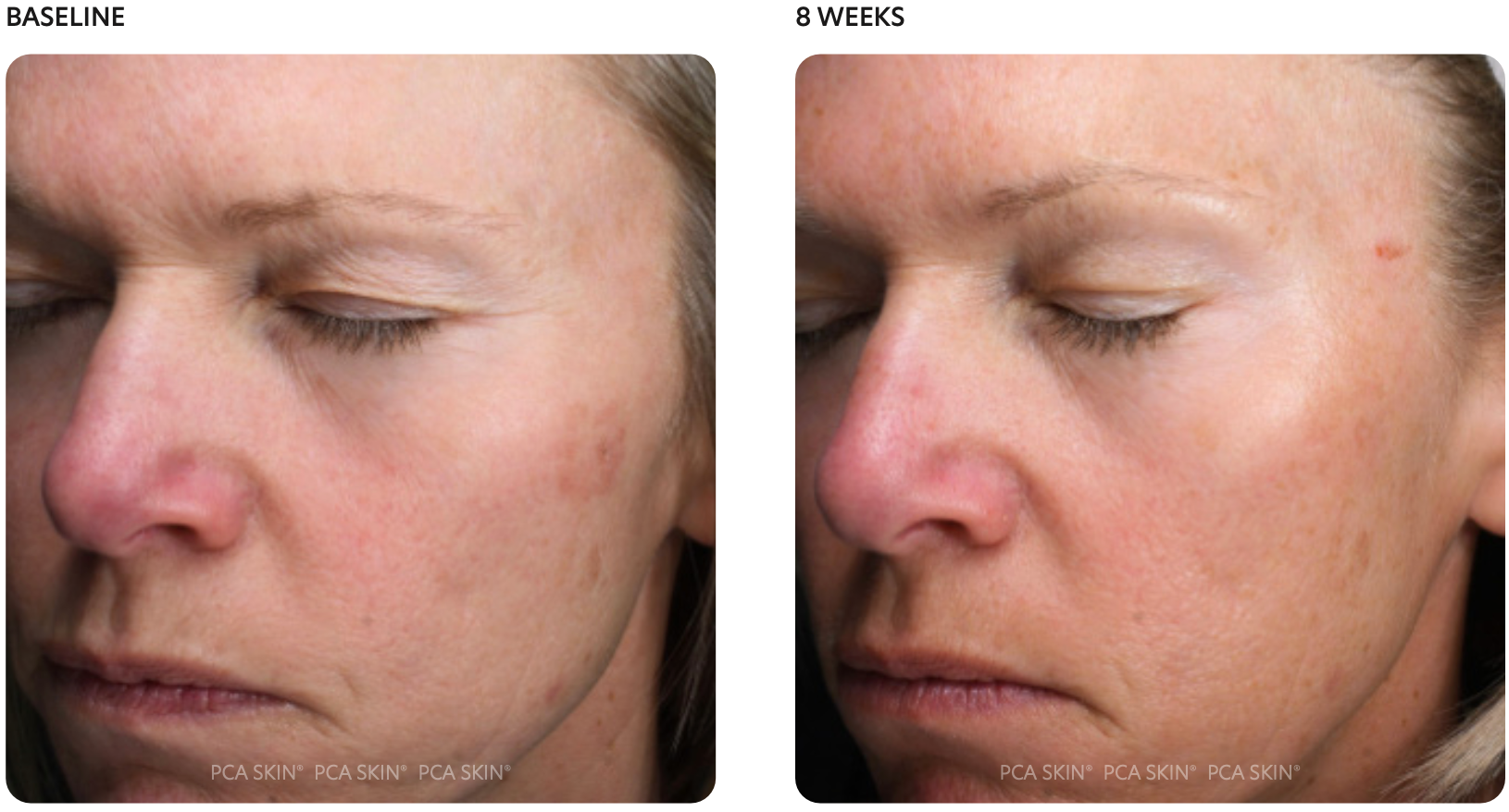 Your Complete Guide to PCA Chemical Peels at InnoVitale Spa