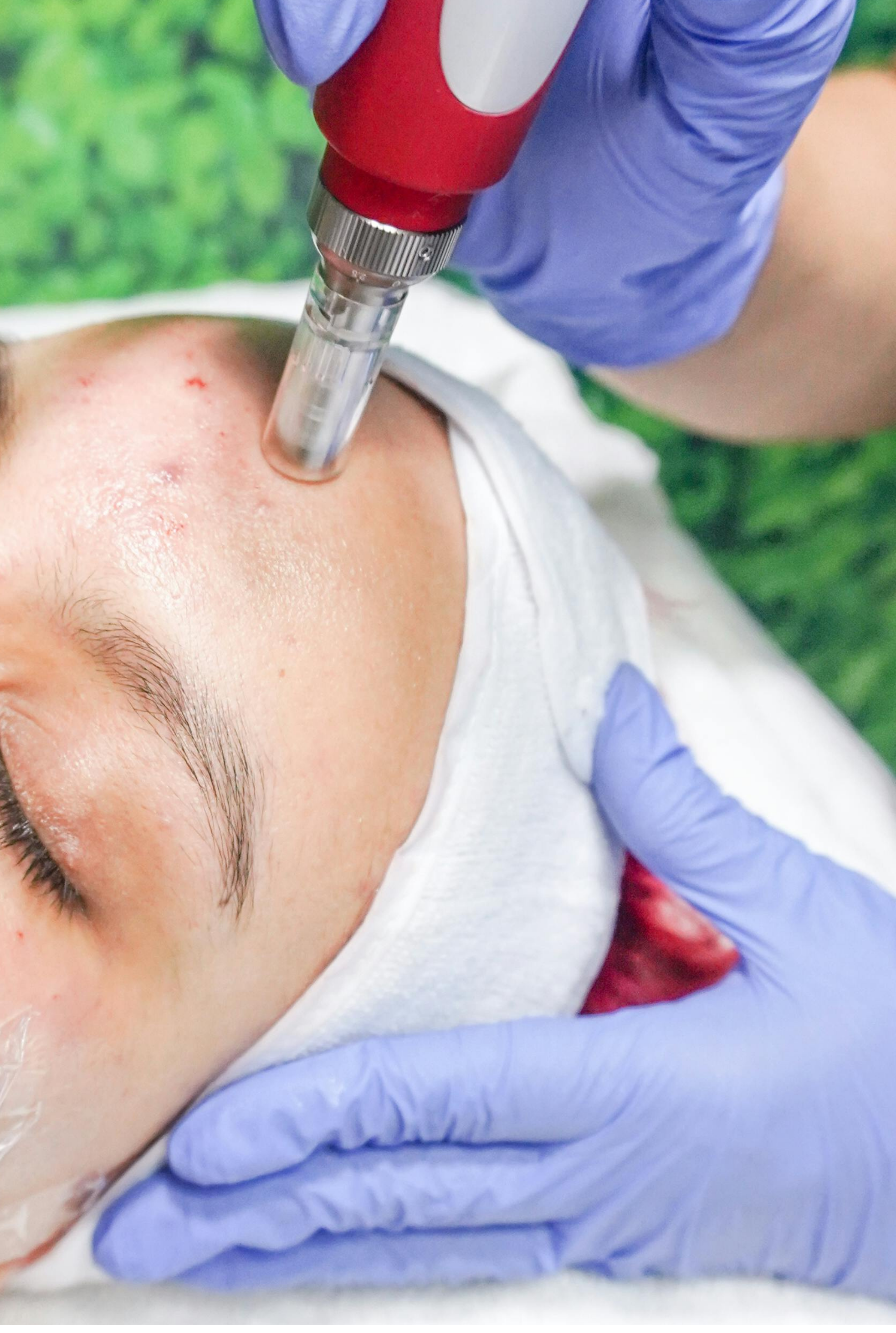 Exploring the Benefits of Microdermabrasion for Glowing Skin